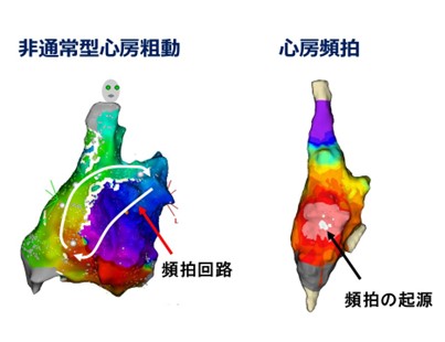 心房粗動・心房頻拍のカテーテルアブレーション