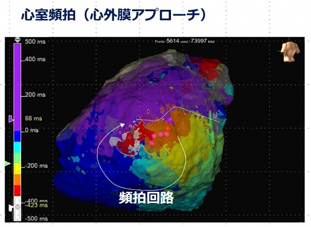 心室期外収縮・心室頻拍のカテーテルアブレーション