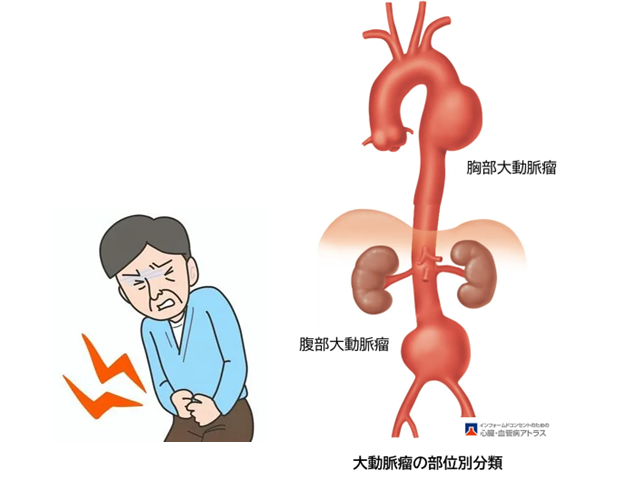 大動脈瘤の部位別分類