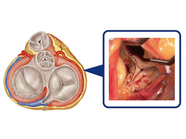 大動脈弁狭窄症