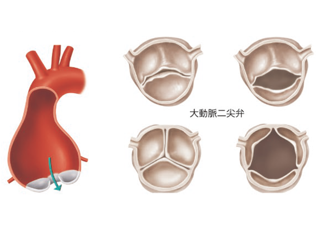 大動脈二尖弁