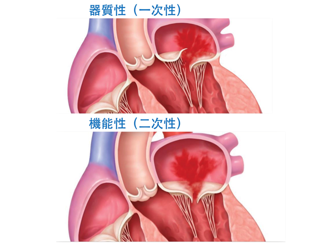 僧帽弁閉鎖不全症